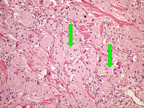 Z 8-11 granular cell tumor nador z granularnich bunek 20x oznaceno.jpg