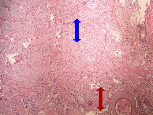 Z 8-11 granular cell tumor nador z granularnich bunek 4x oznaceno.jpg
