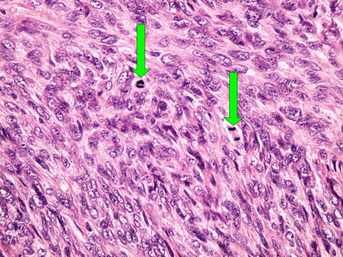 Z 8-13 leiomyocellular sarcoma leiomyocelularni sarkom 40x oznaceno.jpg
