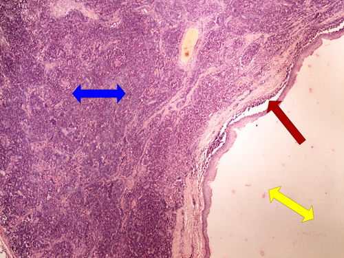Z 8-4 branchial cleft cyst branchiogenni cysta 4x oznaceno.jpg