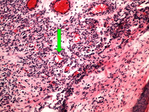 Z 8-9 capillary haemangioma skin kapilarni hemangiom kuze 20x oznaceno.jpg