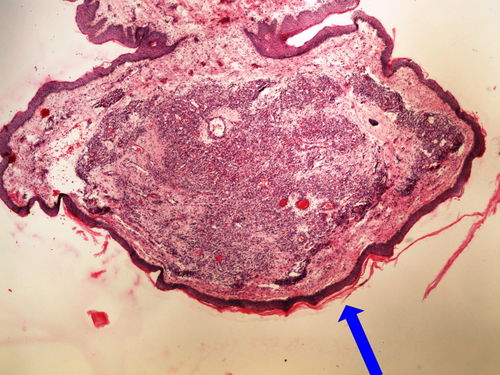 Z 8-9 capillary haemangioma skin kapilarni hemangiom kuze 4x oznaceno.jpg