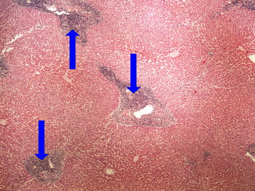 Z 9-12 CLL liver infiltrace jater pri CLL 4x oznaceno.jpg