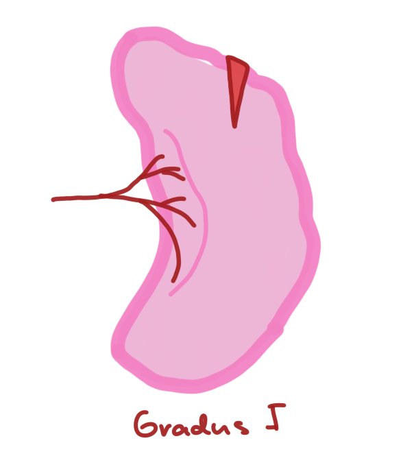 SpleenInjuryGradeI.jpeg