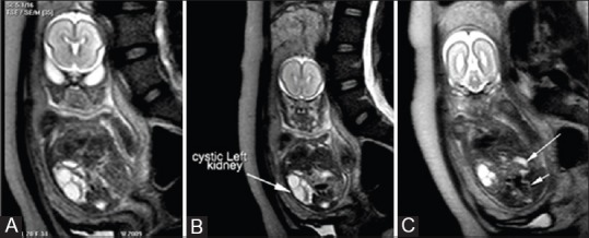 Značný oligohydramniom s agenezi pravý ledviny a moč. měchýřu