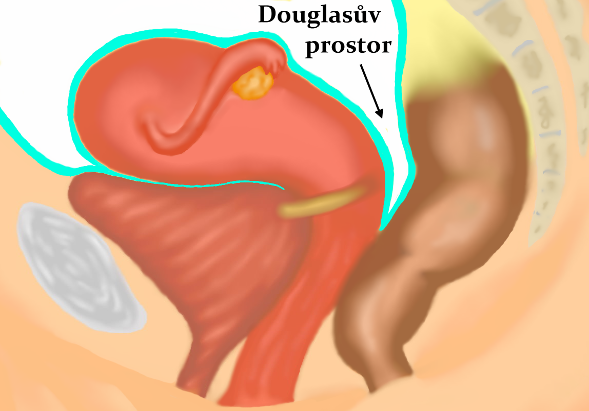 Douglasův prostor – schéma