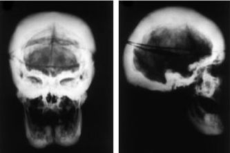 RTG kalvy - nárast kostní hmoty u van Buchemovy nemoci