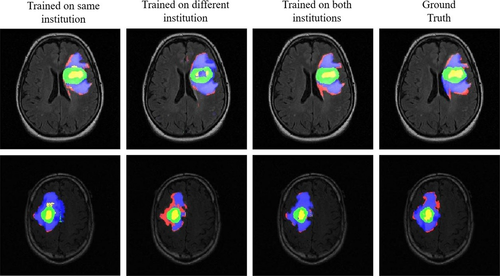 Vizuální interpretace klasifikace MRI snímků neuronové sítě. Zajímavé je porovnání výsledků 3. a 4. sloupce - trained on both institutions vs. ground truth.
