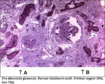 Sklerotické renální glomeruly