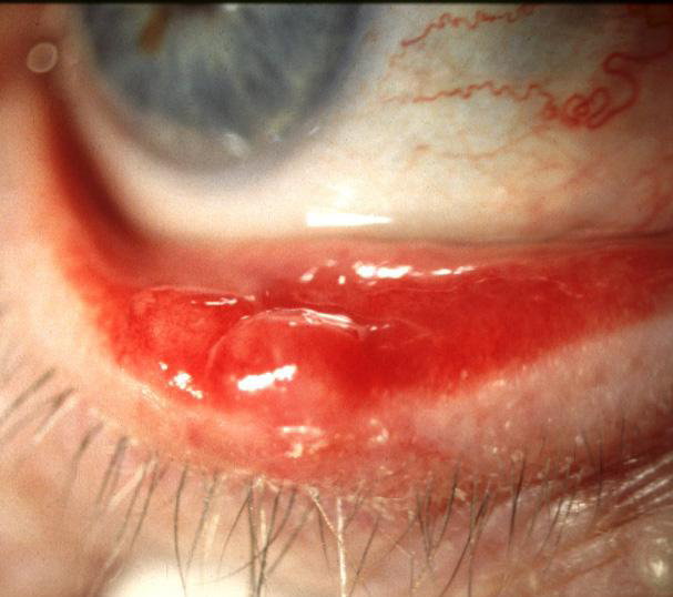 Chalazion