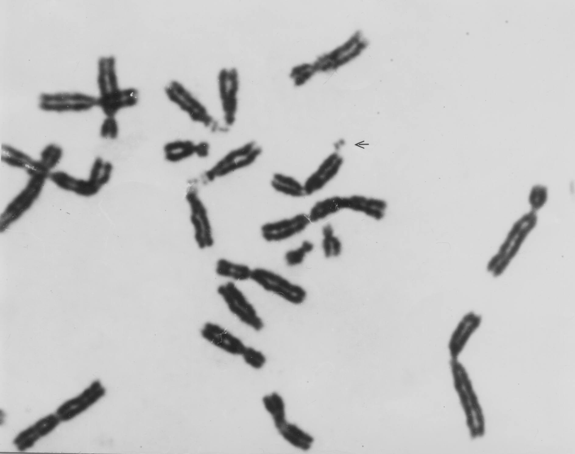 Fragilní místo na Xq27.3 u pacienta s X vázanou mentální retardací.