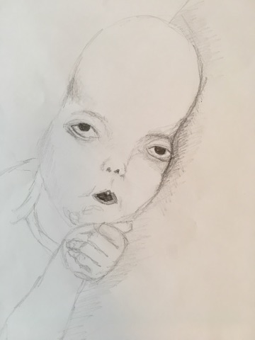 Goldberguv syndrom.jpg