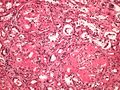 Amyloidosis kidney amyloidoza ledviny HE 20x.jpg