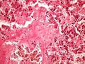Amyloidosis liver amyloidoza jater HE 20x.jpg