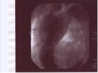Aortografie disekce aorty 2.jpg