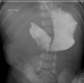 RTG snímek hodinu po podání kontrastu do žaludku k potvrzení diagnózy u atrézie duodena