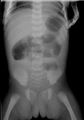 RTG břicha ve visu u donošeného novorozence s atrézií jejuna IV. typu