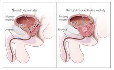 Srovnání normální a hyperplastické prostaty