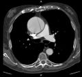 CT disekce aneurysmatické ascendentní aorty