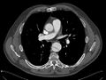 CT disekce descendentní aorty