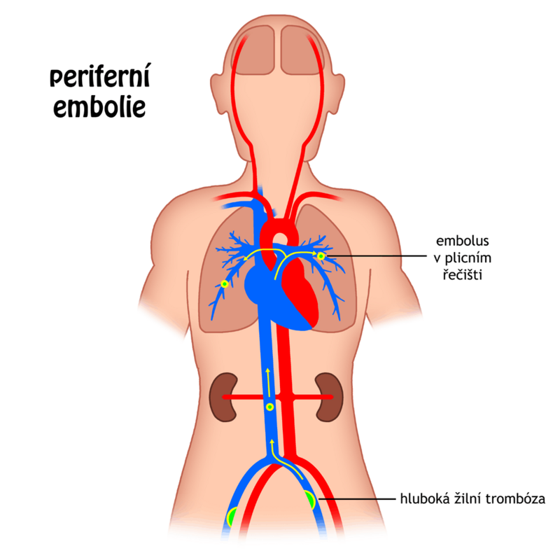 Jak dlouho se marodi s plicní embolii?