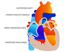 defekt komorového septa dextropozice aorty stenóza plicnice hypertrofie pravé komory