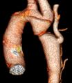 CT 3D rekonstrukce koarktace aorty – detail