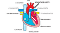 Schéma koarktace aorty