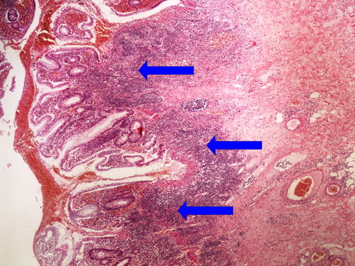 L 6-7 ulcerous colitis ulcerosni kolitis 4x oznaceno.jpg