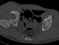 CT dorzokraniální luxace pravé kyčle