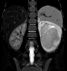 MRI snímek zachycující nefroblastom levé ledviny u šestileté pacientky