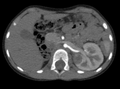 CT snímek - nefroblastom u čtyřleté pacientky se solitární zdvojenou ledvinou