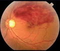 Okluze větve vena centralis retinae.jpg