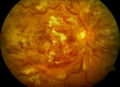 Okluze vena centralis retinae.jpg