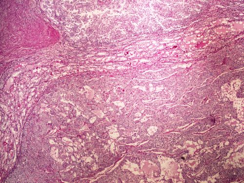 PAS (clear cell renal cell carcinoma) PAS (Grawitzuv ca) 4x.jpg