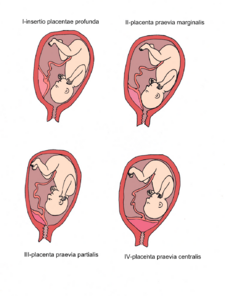 Patologické uložení placenty v děloze