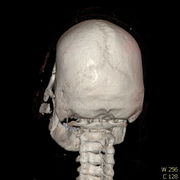 Polytrauma lebka S023 I0000.jpg
