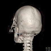 Polytrauma lebka S023 I0001.jpg