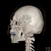 Polytrauma lebka S023 I0003.jpg