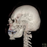 Polytrauma lebka S023 I0004.jpg