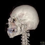 Polytrauma lebka S023 I0005.jpg