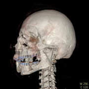 Polytrauma lebka S023 I0006.jpg