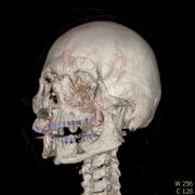 Polytrauma lebka S023 I0007.jpg