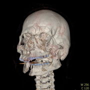 Polytrauma lebka S023 I0008.jpg