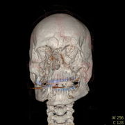 Polytrauma lebka S023 I0009.jpg