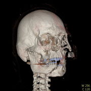 Polytrauma lebka S023 I0011.jpg