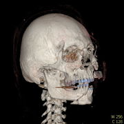 Polytrauma lebka S023 I0012.jpg