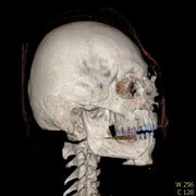 Polytrauma lebka S023 I0013.jpg