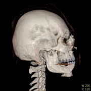 Polytrauma lebka S023 I0014.jpg