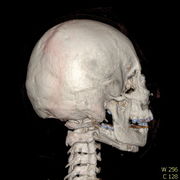 Polytrauma lebka S023 I0016.jpg